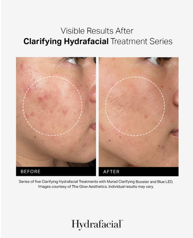 Before and after comparison of facial skin treatment with Hydrafacial branding.